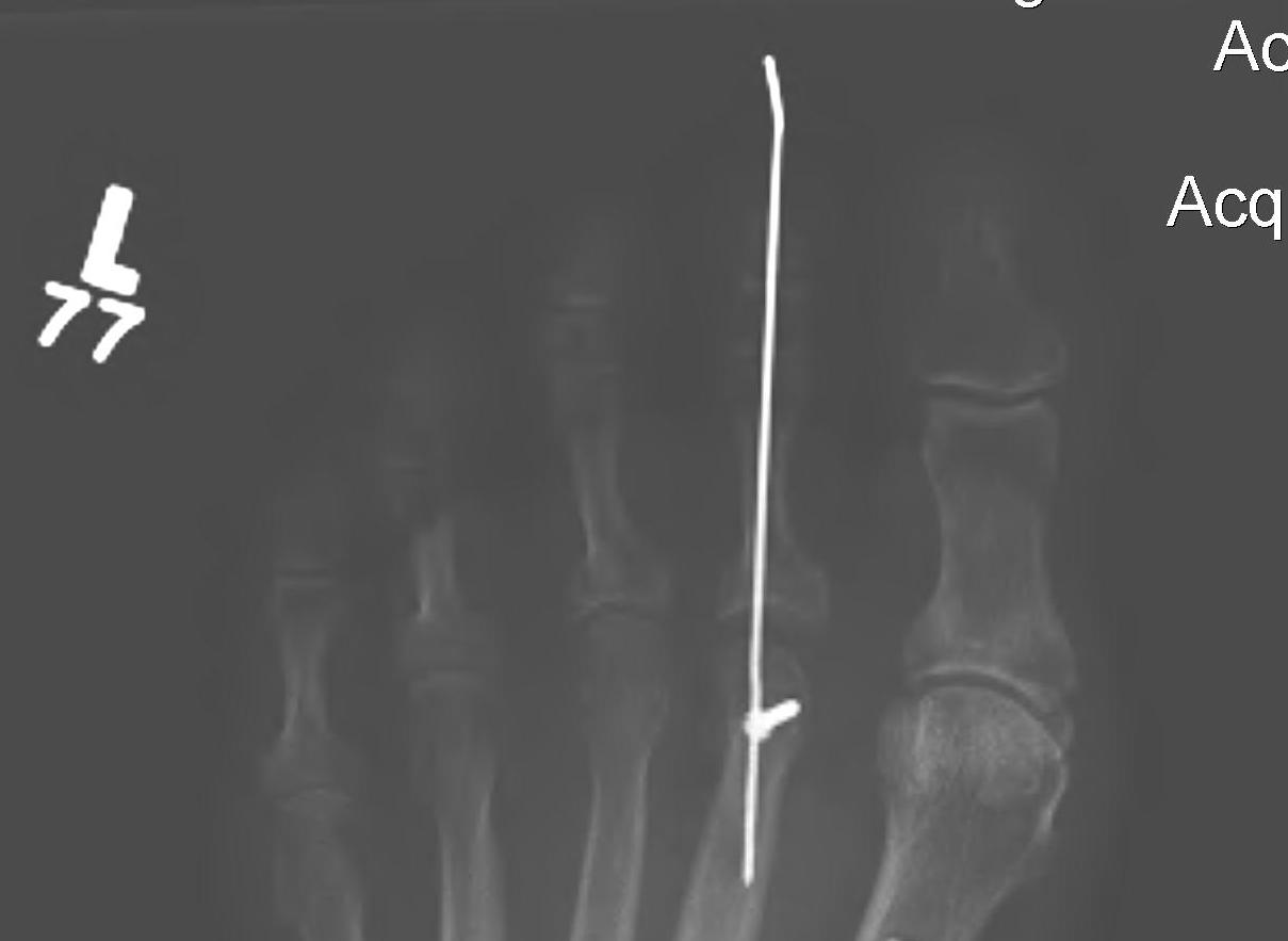 Hammer Toe The Bone School